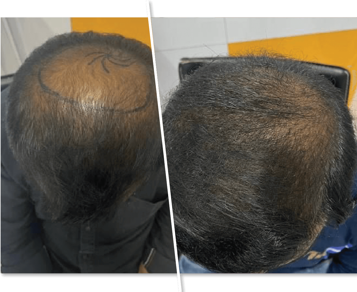 Hair Loss Treatment Before and After